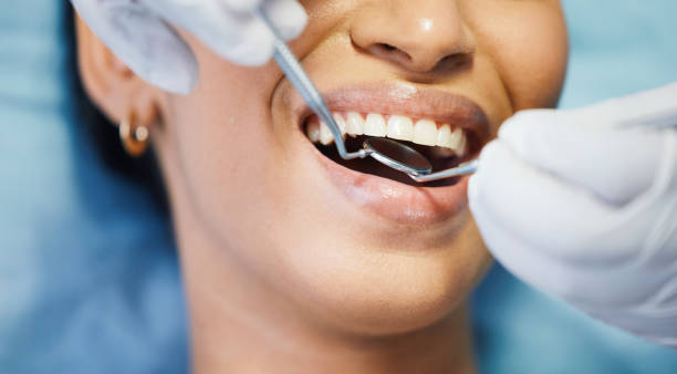 Best Knocked-Out Tooth (Avulsed Tooth) Treatment in New Philadelphia, OH